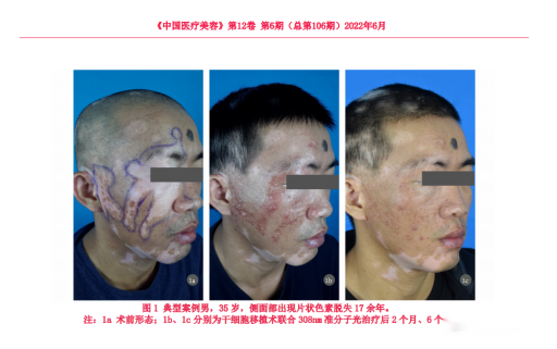 干细胞技术在皮肤病领域的应用：涉及银屑病、红斑狼疮、白癜风